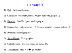 Rétrécissement Aortique