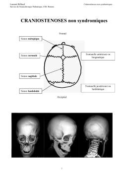 Craniosténoses non syndromiques