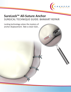 SureLock™ All-Suture Anchor