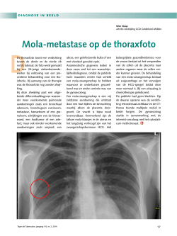 Diagnose in beeld: Mola-metastase op de thoraxfoto