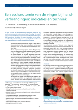 Een escharotomie van de vinger bij hand