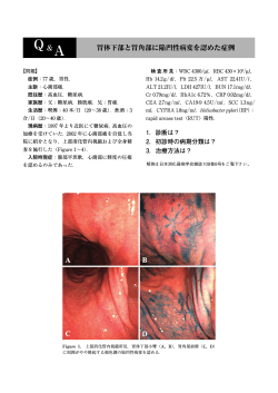 胃体下部と胃角部に陥凹性病変を認めた症例 - 日本消化器病学会