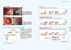 cTis（M）癌およびcT1（SM）癌の治療