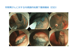 早期胃がんに対する内視鏡的粘膜下層剥離術（ESD）