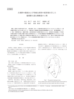 左視野の顔面および単純な図形の変形視を呈した 脳梁膨大部 - J