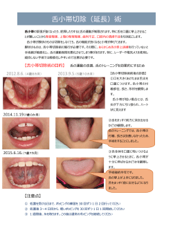 舌小帯切除（延長）術