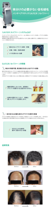 株分けの必要がない自毛植毛