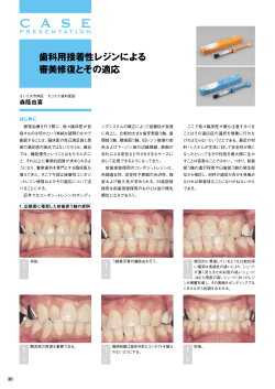 歯科用接着性レジンによる 審美修復とその適応