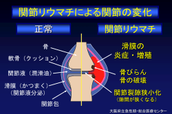 関節リウマチによる関節の変化