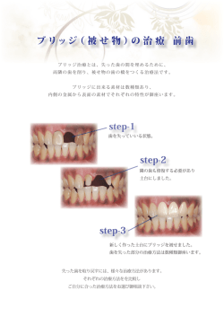 ブリッジ（被せ物）の治療 前歯