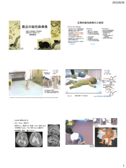 横地「最近の脳性麻痺像」