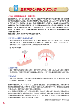 《虫歯・歯槽膿漏の治療：補綴治療》 M