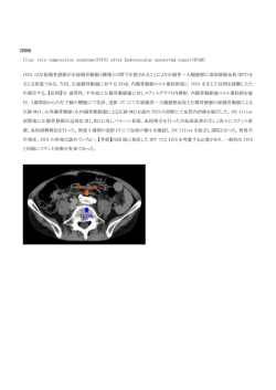 IVCS は左総腸骨静脈が右総腸骨