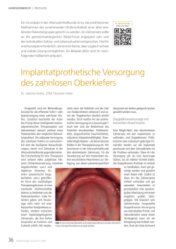 Implantatprothetische Versorgung des zahnlosen