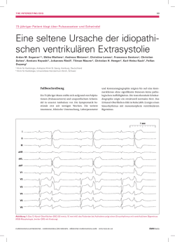 Eine seltene Ursache der idiopathi- schen ventrikul&auml;ren Extrasystolie