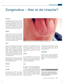 Zungenulkus &ndash; Was ist die Ursache?