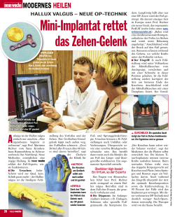 Mini-Implantat rettet das Zehen-Gelenk