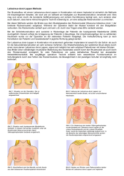 Musculus latissimus dorsi-Lappen - BRCA