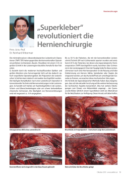 „Superkleber“ revolutioniert die Hernienchirurgie