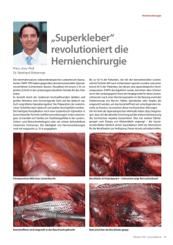 „Superkleber“ revolutioniert die Hernienchirurgie