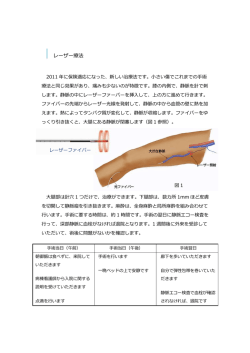血管内レーザー治療についてはこちら