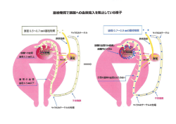 塞栓物質で筋腫への血液流入を阻止している様子