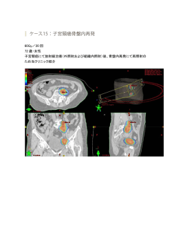 60Gy／20 回 72 歳・女性 子宮頸癌にて放射線治療（外照射および組織