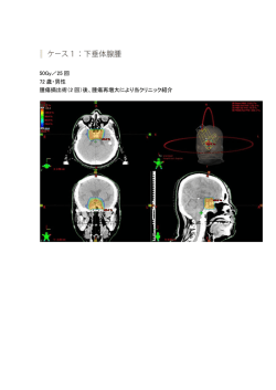 50Gy／25 回 72 歳・男性 腫瘍摘出術（2 回）後、腫瘍再増大により当