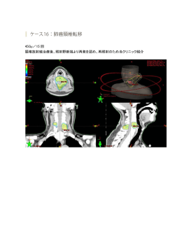 45Gy／15 回 頸椎放射線治療後、照射野断端より再発を認め、再照射の