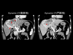 Dynamic CT(動脈相) Dynamic CT(門脈相)