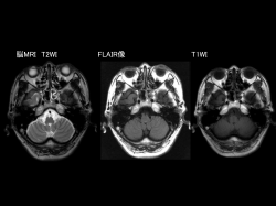 脳MRI T2WI FLAIR像 T1WI