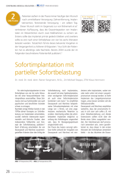 Sofortimplantation mit partieller Sofortbelastung