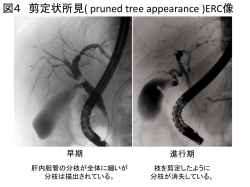 剪定状所見（pruned tree appearance）