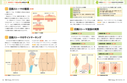 回腸ストーマのサイトマーキング