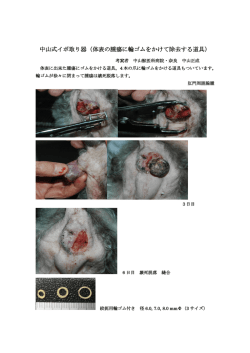 中山式イボ取り器（体表の腫瘍に輪ゴムをかけて除去