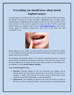 Everything you should know about dental implant surgery