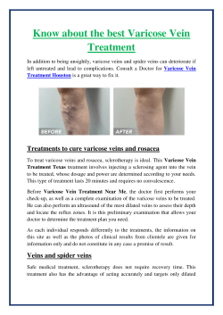 Know about the best Varicose Vein Treatment